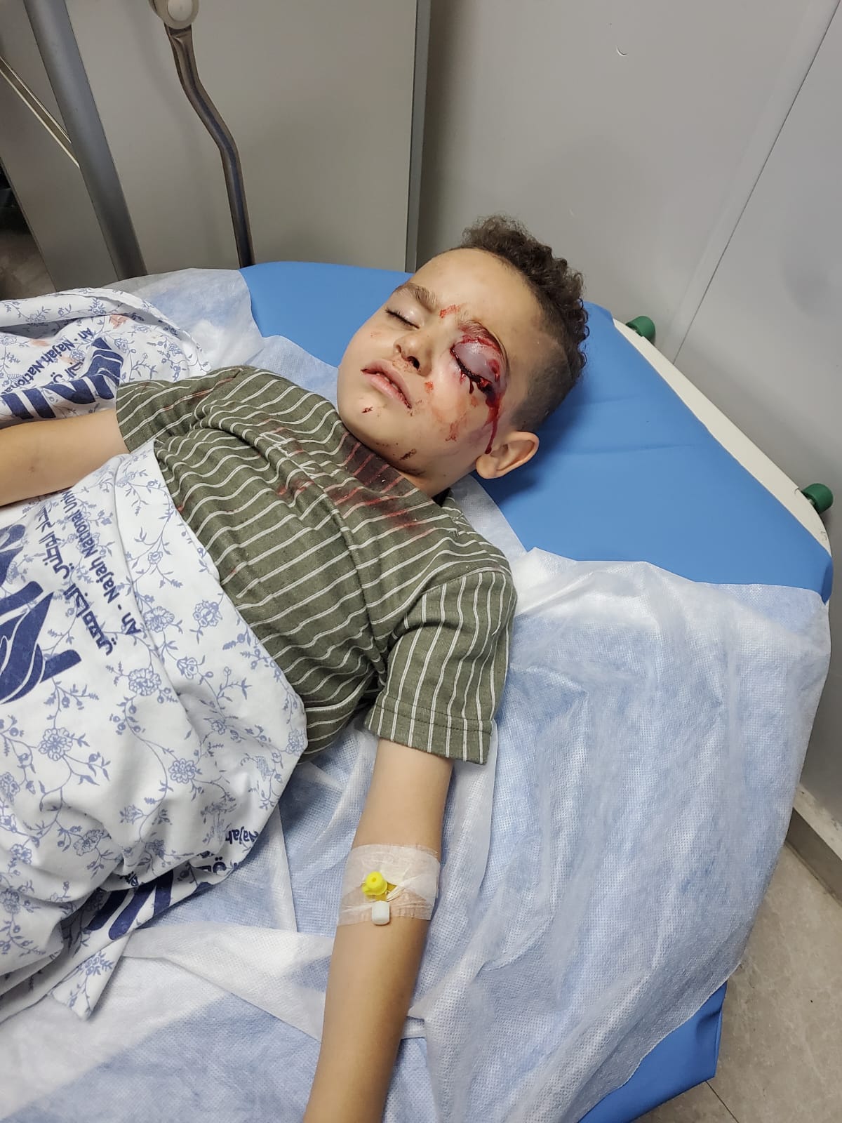 Five-year-old Khaled Akram Khaled Malalha lost his left eye after Israeli forces shot him in the head with live ammunition. (Photo: Courtesy of the Malalha family)